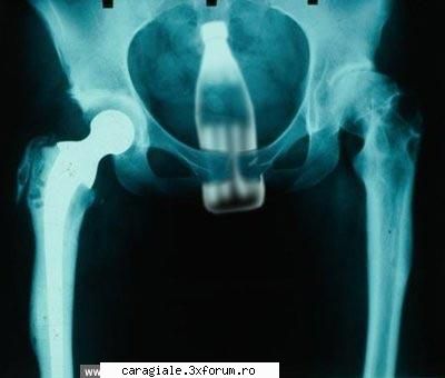 Imagini - am si eu cu radiografii: OUCH!!!! - Recycle Bin Laden